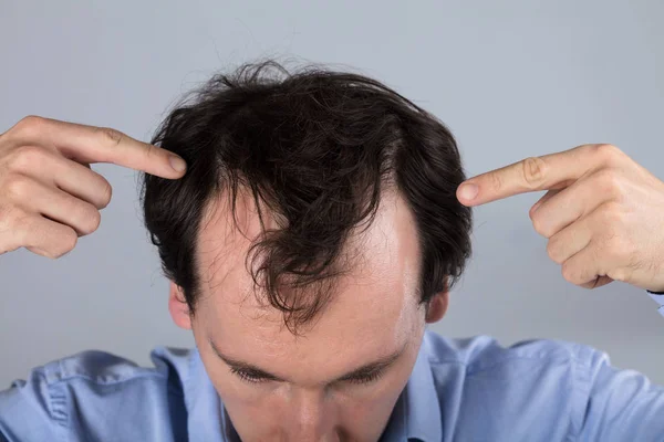 Primo Piano Della Testa Uomo Con Sintomi Perdita Capelli — Foto Stock