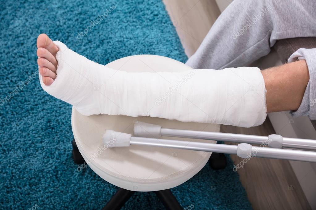 Elevated View Man Broken Leg Cast — Stock Photo ...