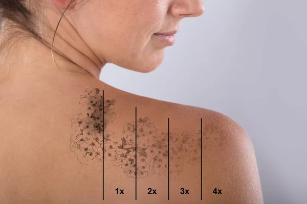 Laser Tattoo Removal On Woman\'s Shoulder Against Gray Background