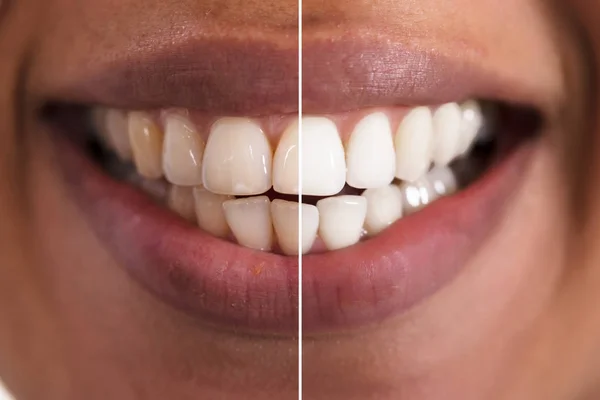 Close Dentes Mulher Sorridente Antes Depois Clareamento — Fotografia de Stock