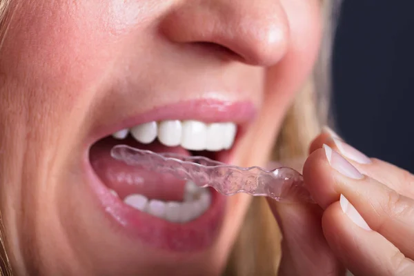 Close Woman Hand Putting Transparent Aligner Teeth — Stock Photo, Image