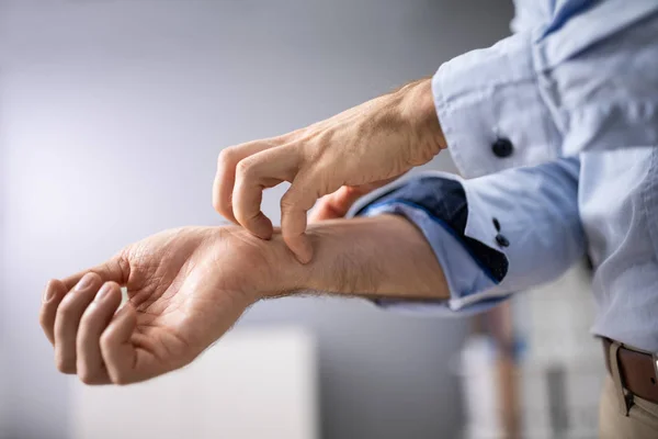 Primer Plano Hombre Rascándose Mano — Foto de Stock