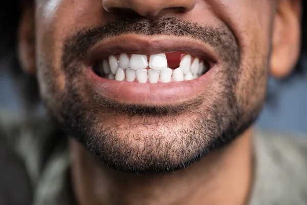 Крупный План Фото Молодого Человека Отсутствующим Зубом — стоковое фото