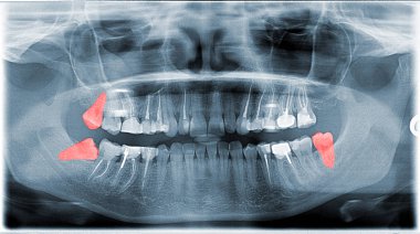 Full Frame View Of Dental Jaw X-ray With Wishdom Teeth clipart