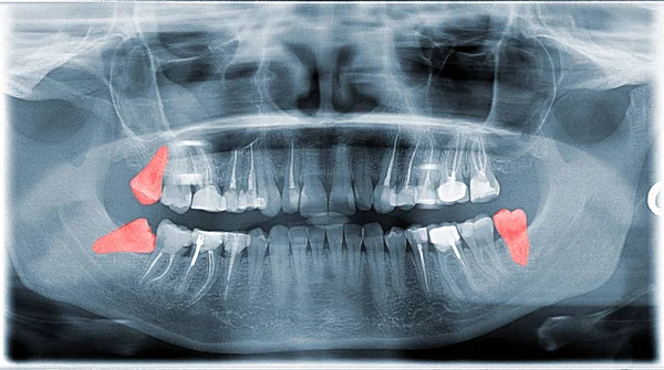 Full Frame View Of Dental Jaw X-ray With Wishdom Teeth