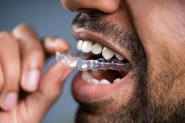 Close Man Hand Putting Transparent Aligner Teeth — 스톡 사진