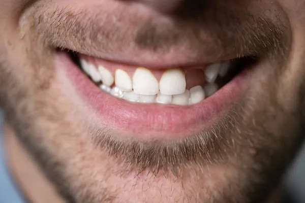 Man missing teeth Stock Photos, Royalty Free Man missing teeth Images