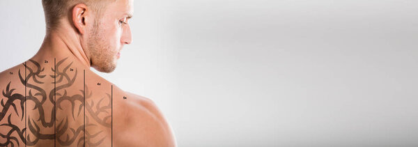 Laser Tattoo Removal On Man's Shoulder Against White Background