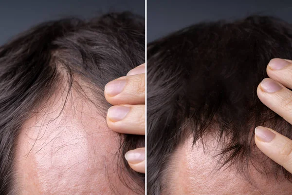 Mężczyzna Przed Udanym Leczeniu Wypadania Włosów — Zdjęcie stockowe