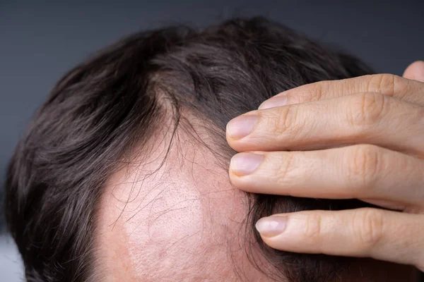 Close Young Man Checking Hairline Home — Stock Photo, Image