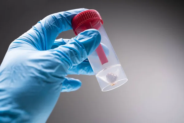 Doctor Hand Met Plastic Container Bemonstering Van Uitwerpselen — Stockfoto