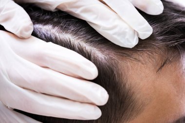 Bir Dermatoloğun Eli Hastanın Saçını Kontrol Ediyor