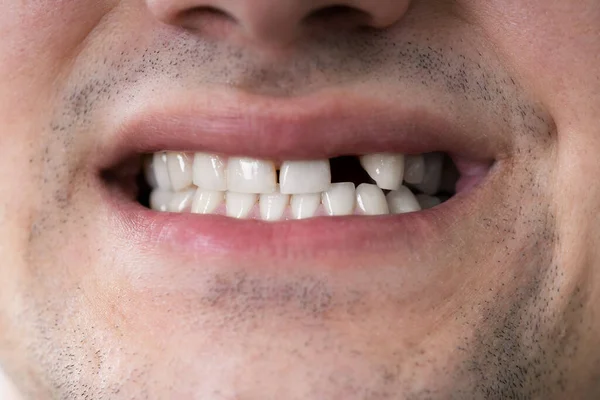 Close Photo Young Man Missing Tooth — Stock Photo, Image