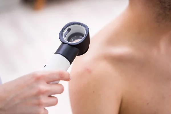 Bliska Osoba Ręce Zbadanie Skóry Trądzikowej Człowieka Dermatoscope — Zdjęcie stockowe