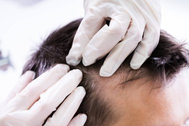 Bir Dermatoloğun Eli Hastanın Saçını Kontrol Ediyor