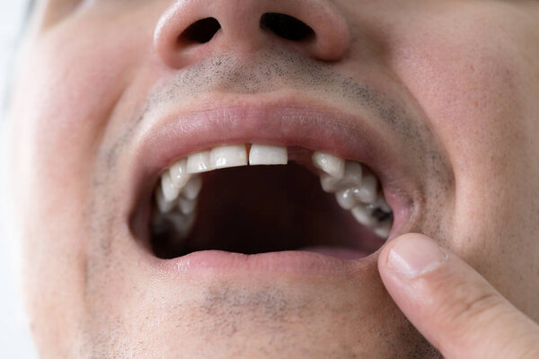 Close Up Photo Of Young Man With Missing Tooth