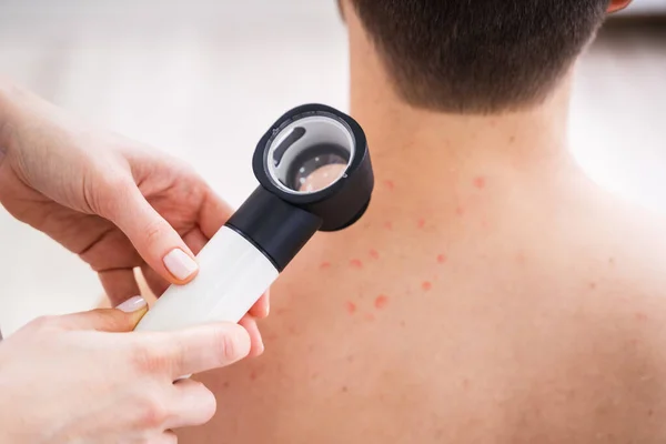 Närbild Person Händerna Undersöka Akne Hud Man Med Dermatoscope — Stockfoto