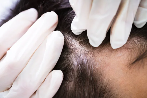 Крупный План Руки Дерматолога Проверяющего Волосы Пациента — стоковое фото