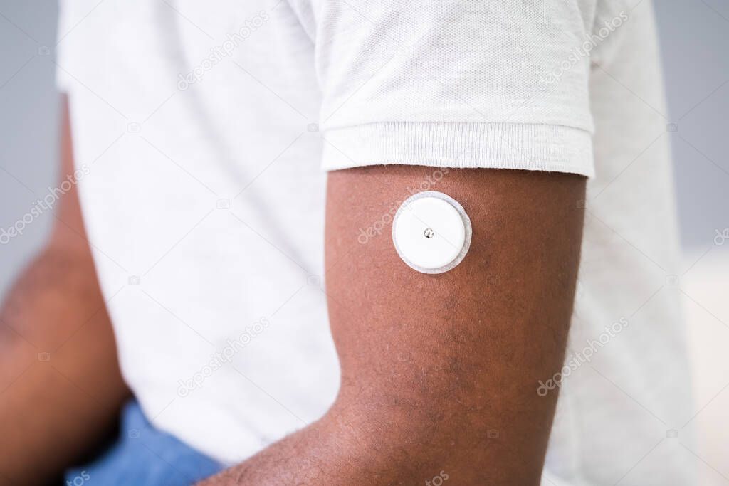 Close-up Of A Man Testing Glucose Level With A Continuous Glucose Monitor On His Arm