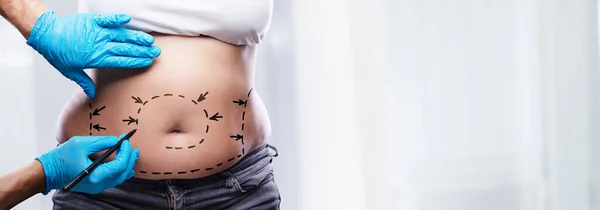 Liposucción Cirugía Plástica Abdominoplastia Para Reducir Grasa —  Fotos de Stock