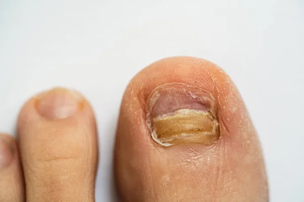 骨折男性の足の爪と真菌感染症 — ストック写真