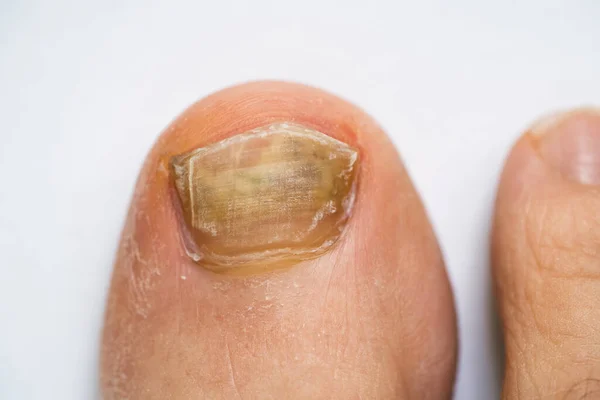 Broken Male Foot Nail Fungal Infection — Stock Photo, Image