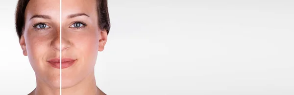 Före Laser Face Mikrodermabrasion Kosmetisk Behandling Kvinnor — Stockfoto