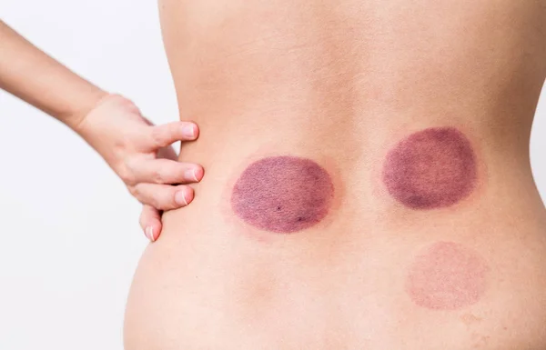 Vrouw bloed merken gemasseerd met cupping therapie — Stockfoto