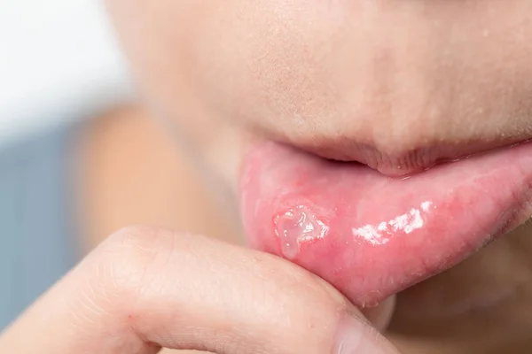 Kobieta cierpi na afty w jamie ustnej — Zdjęcie stockowe