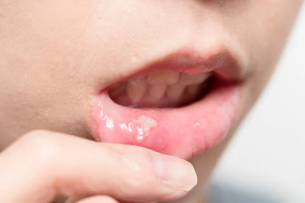 Femme souffrent d'aphtha sur la bouche — Photo