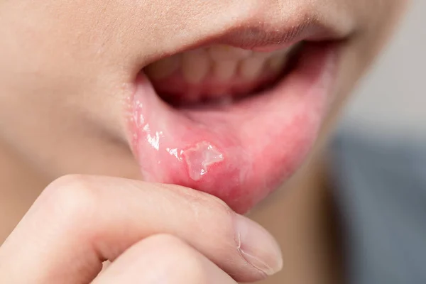 Woman suffer from aphtha on mouth — Stock Photo, Image