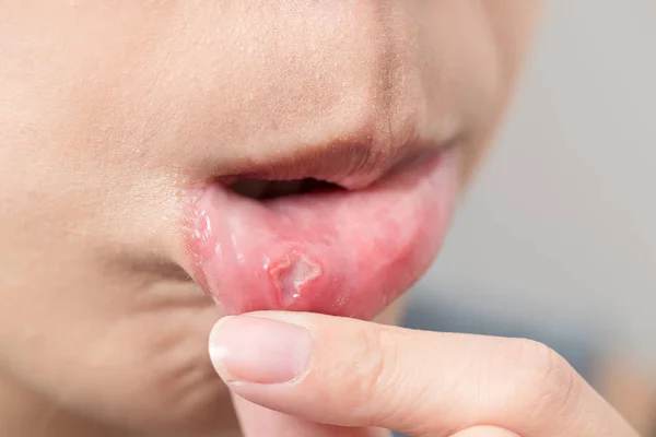 Женский рот страдает от афты — стоковое фото