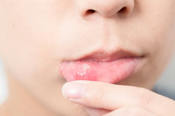 Donna soffrono di afta bocca — Foto Stock