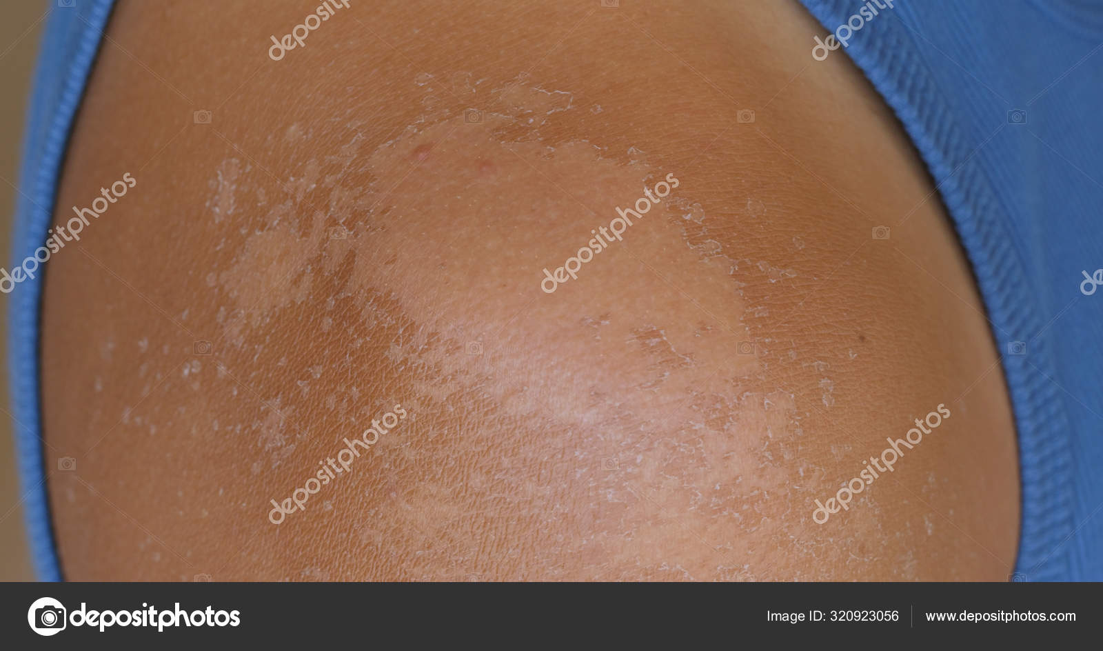 Sunburned skin, peeling skin from a sunburn — Stock Photo © leungchopan