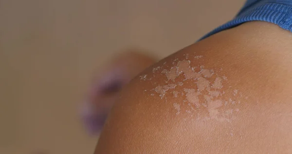 Sunburned skin, peeling skin from a sunburn — Stock Photo, Image