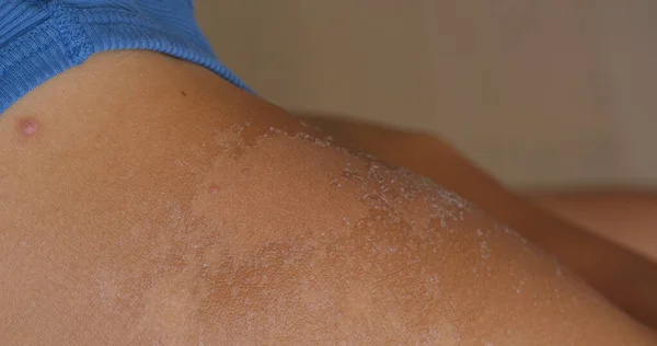 Загорелая кожа, очищающая кожу от солнечных ожогов — стоковое фото