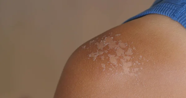 Sunburned skin, peeling skin from a sunburn — Stock Photo, Image