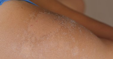 Güneş yanığı derisi, güneş yanığı derisi.