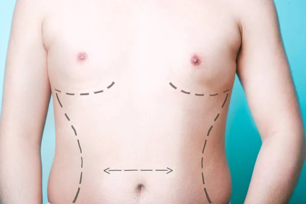 Man's body with plastic surgery lines — Stock Photo, Image