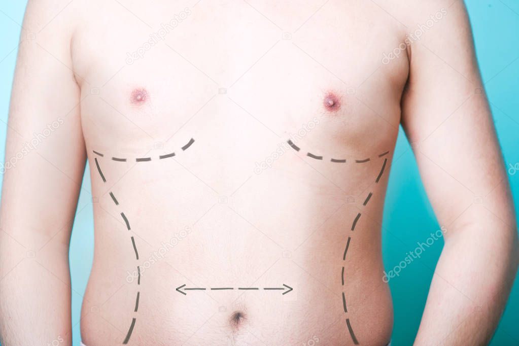 Man's body with plastic surgery lines