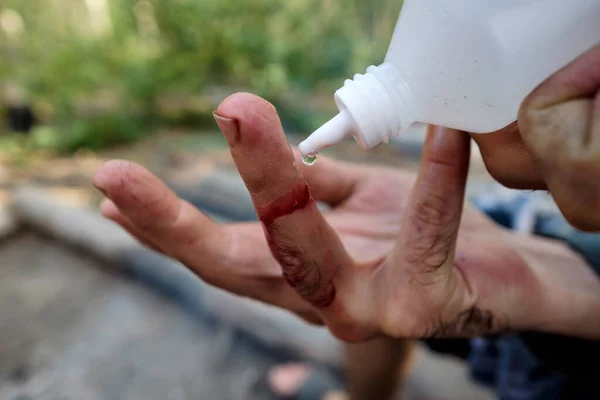 Hombre Trata Corte Con Peróxido Desinfecta Una Herida Mientras Está —  Fotos de Stock