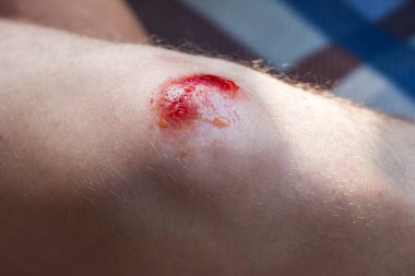 Kırık diz. Çürükler ve ıslak izlerle deride derin çizikler var.