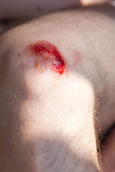 Gebroken Bloedende Knie Diepe Krassen Huid Met Blauwe Plekken Natte — Stockfoto