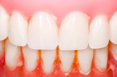 Kullanılan diş protezi görünür plakla kapat