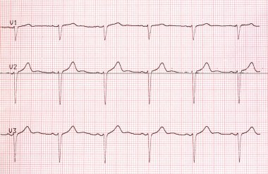 Elektrokardiyogram grafik kağıt üzerinde