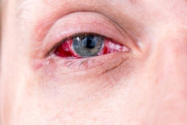 selektif odak ve bulanıklık ile postoperatif ağır iltihaplı göz closeup çekim