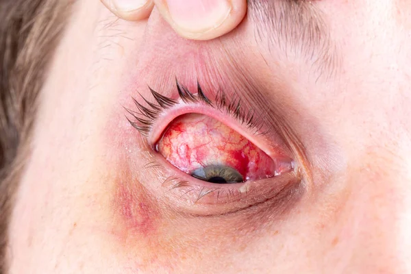 Ameliyat Sonrası Yoğun Iltihaplı Göz Mermisi Seçici Odaklanma Bulanıklık Ile — Stok fotoğraf