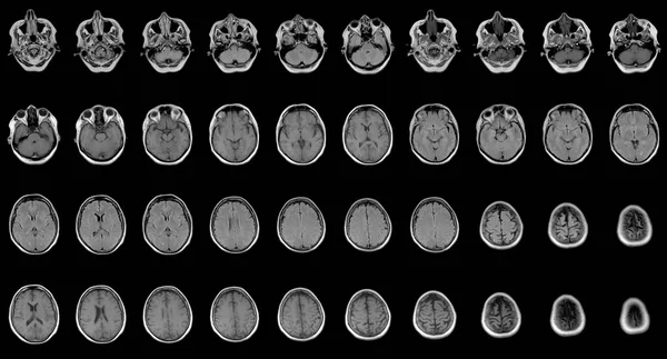 Conjunto de exames de RM seriados de cabeça feminina caucasiana de sessenta anos — Fotografia de Stock
