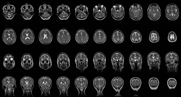 Zestaw seryjnych skanów MRI 60-letniej głowy białej kobiety w płaszczyznach czołowych i poziomych — Zdjęcie stockowe