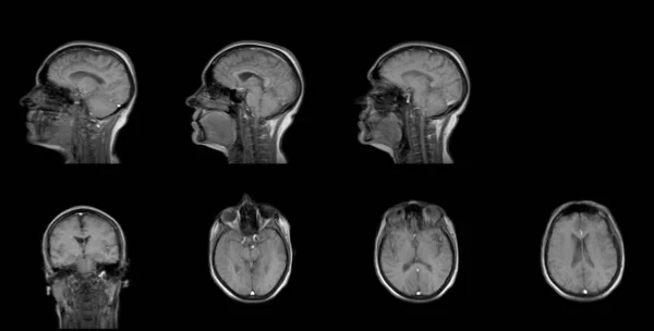 Набор последовательных МРТ шестидесятилетней белой женской головы в сагиттальных и горизонтальных плоскостях — стоковое фото